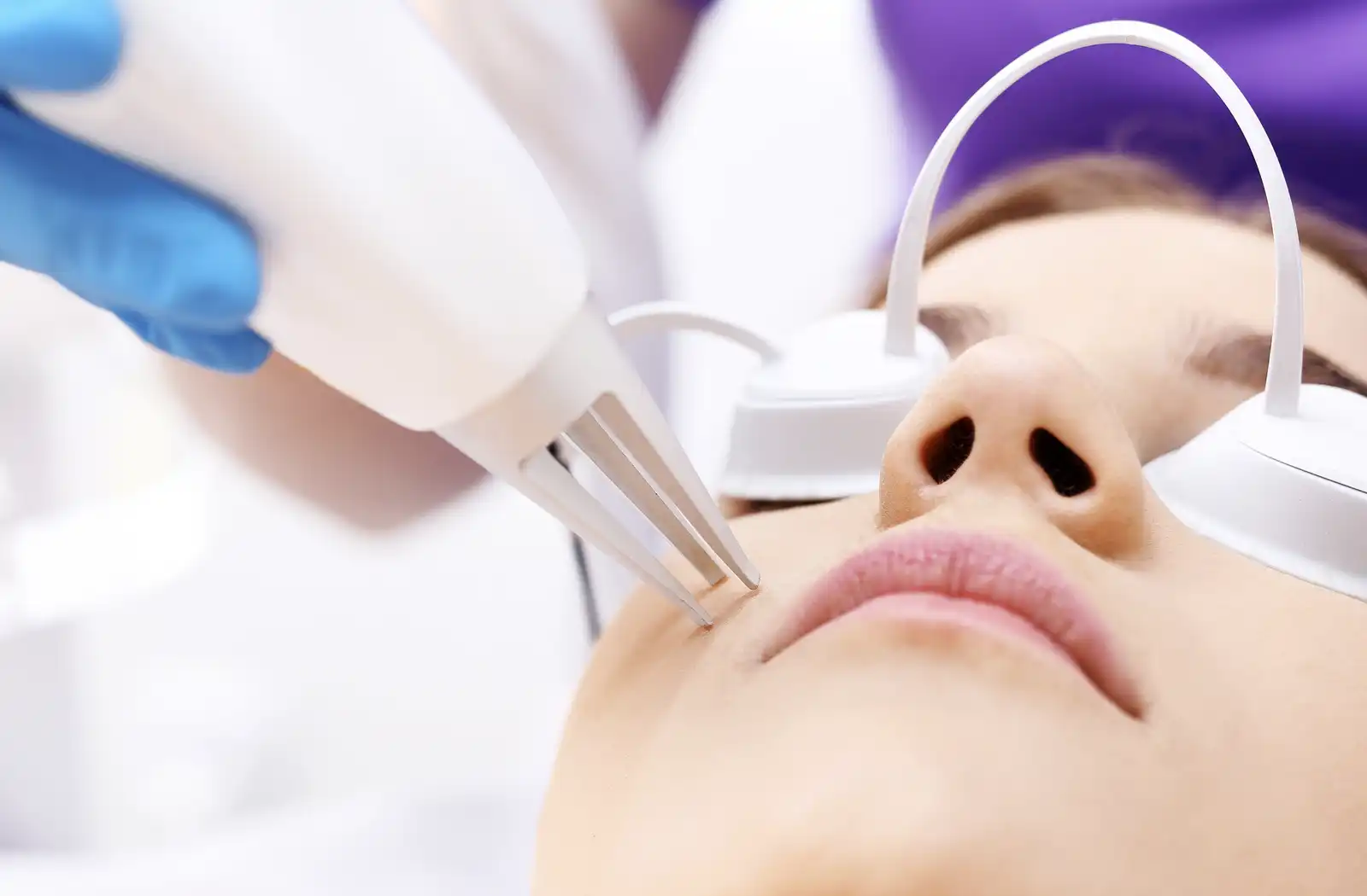 laser-acne-treatment